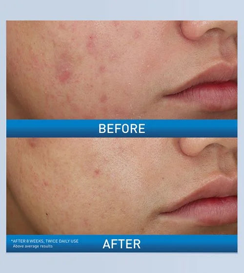 CeraVe Acne Foaming Cream Wash with 10% Benzoyl Peroxide 150g
